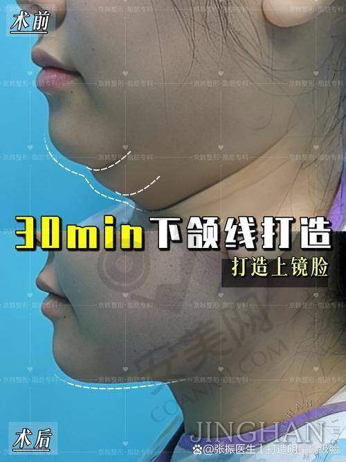 长沙梵童：专精的面部吸脂平台