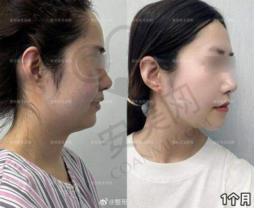 面部吸脂：成效与风险并存