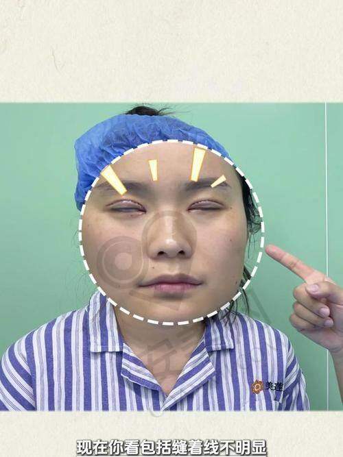 彭太平医生的内眼角修复技术有何独特之处？