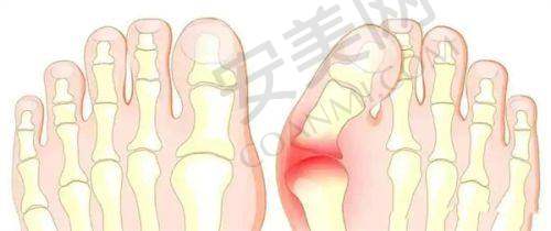 北京马文足科医院拇外翻矫正项目价格是如何构成的？