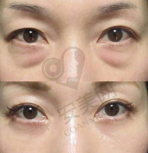 深圳去眼袋的正规医院排行榜前3强