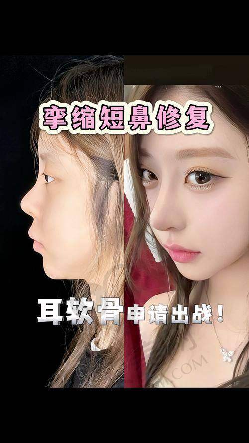 上海联合丽格整形医院挛缩鼻修复技术有什么特色？
