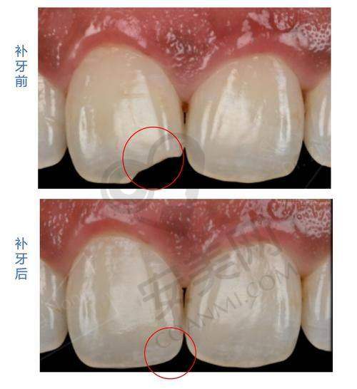 什么是进口树脂补牙？