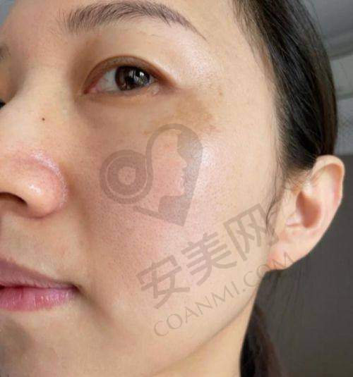 光子嫩肤术后护理需要注意什么？