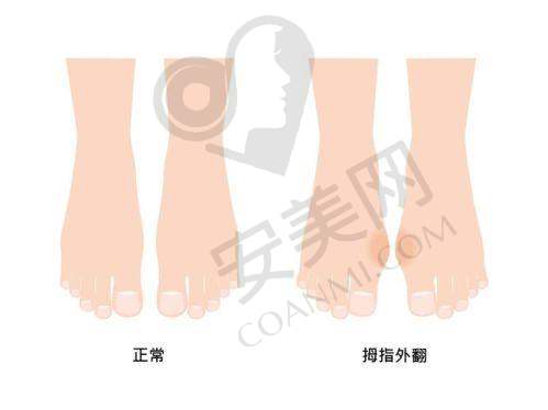 北京马文足科医院拇外翻矫正项目的成功实例有哪些？