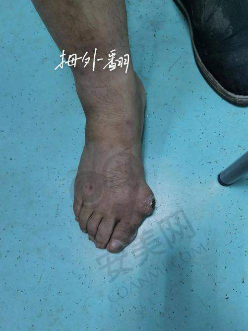 北京马文足科医院拇外翻矫正项目有哪些优势？