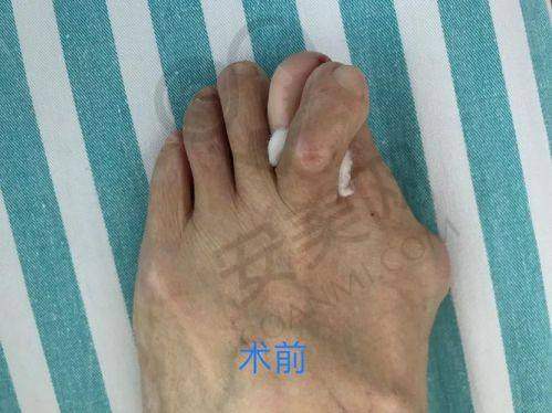 什么是拇外翻？为什么需要矫正？