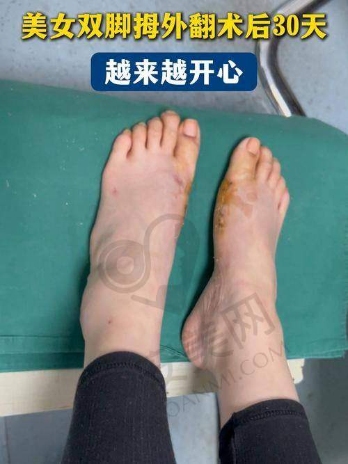 如何选择适合自己的拇外翻矫正医院？