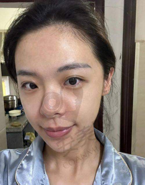 吉首星美整形医院光子嫩肤的优势有哪些？