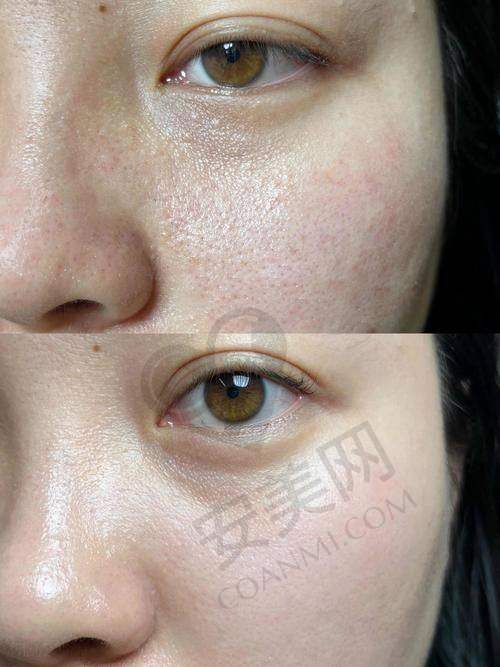 吉首星美整形医院光子嫩肤的价格分阶情况