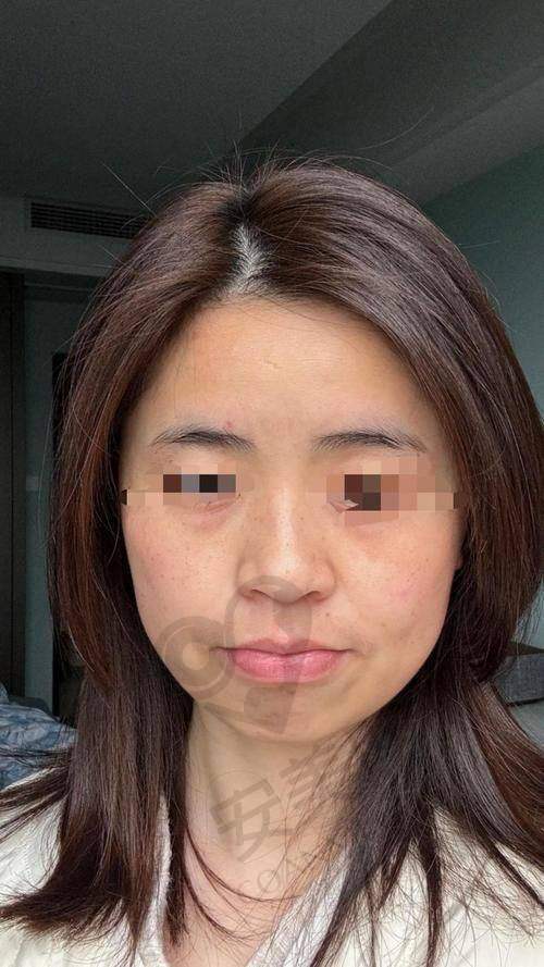光子嫩肤治疗过程是怎样的？