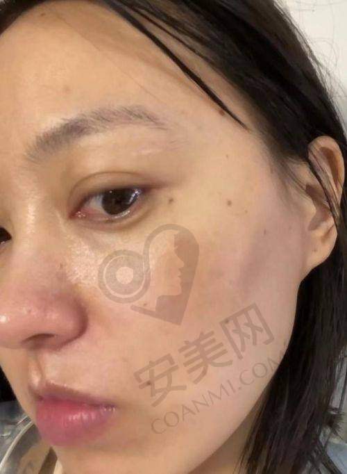 杏枝山祛斑：原理大揭秘