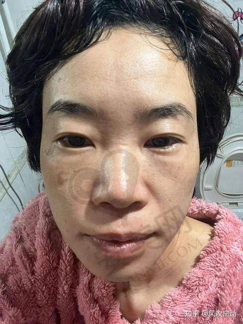 黄褐斑：美丽的“绊脚石”