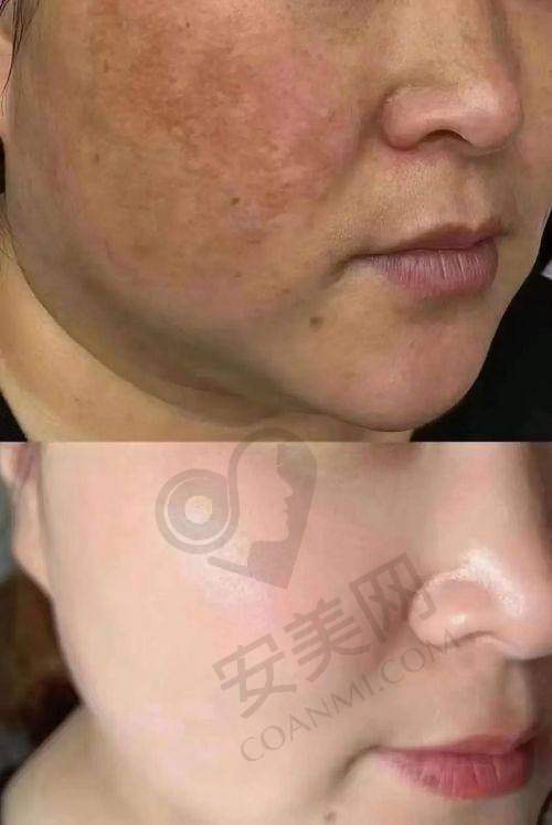 术后护理：巩固成效的关键