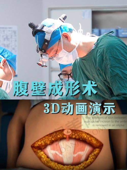 腹壁成形术的医生水平如何？