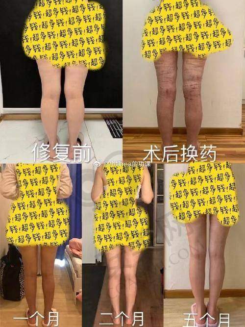 广州军美整形医院吸脂技术的历史与发展如何？