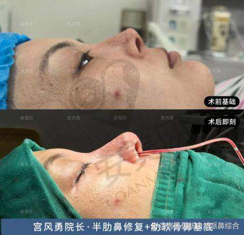 范荣杰院长，拯救鼻整形失败的希望之光