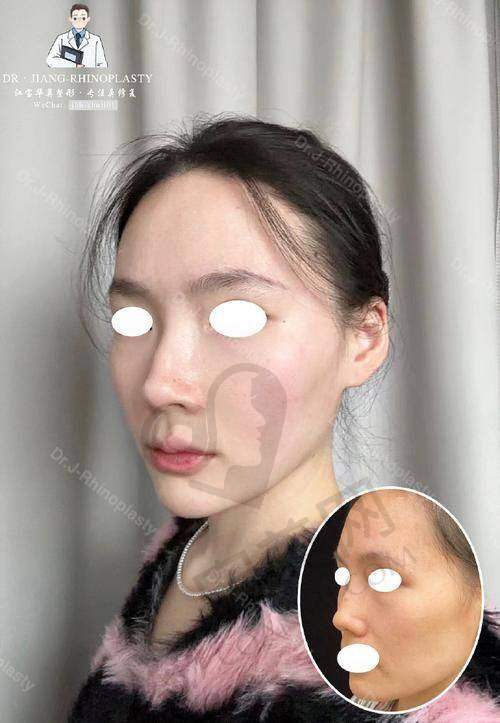 鼻整形失败，你是否陷入困境？