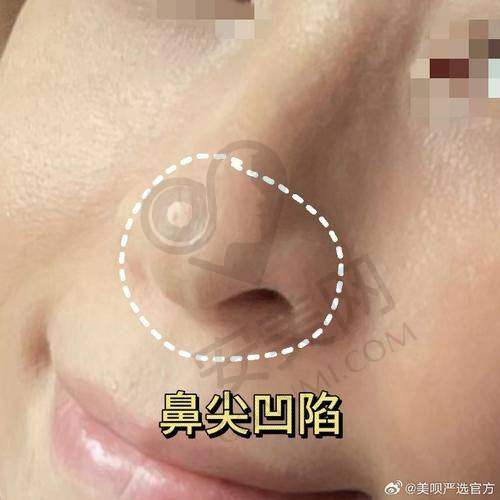 挛缩鼻修复手术过程是怎样的？