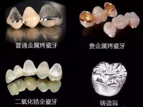 全瓷牙冠修复前需要做哪些检查？