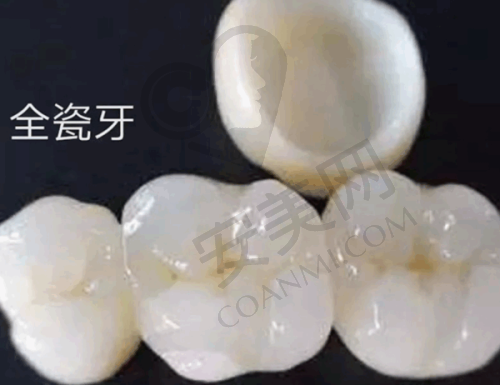 全瓷牙冠修复技术有哪些特色？