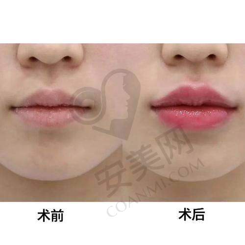 在长沙雅美注射丰唇的总体感受是怎样的呢？