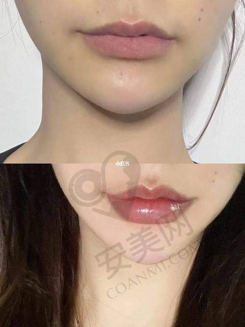 注射丰唇后的成效如何呢？