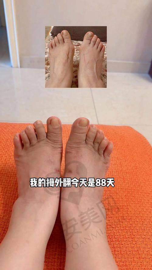 绝望困境：7年畸形大脚骨的痛苦折磨