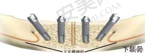 患者对徐州中牙口腔何翀 all - on - 4 半口种植牙的评价如何？