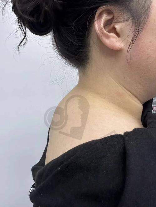 与其他医生相比，叶桐江医生的吸脂技术有何独特之处？