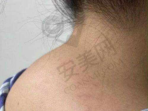 叶桐江医生吸脂成效到底好不好？