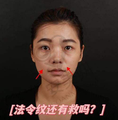 玻尿酸填充法令纹：神奇的变得更美魔法