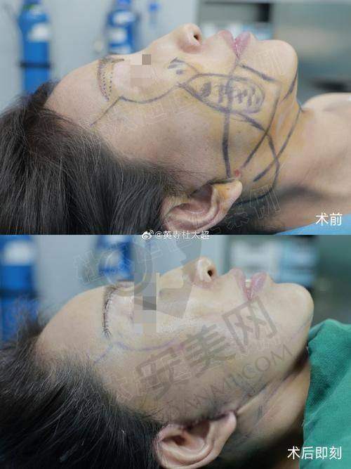 上海伯思立小切了拉皮提升技术的特色在哪里？