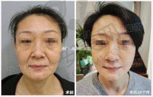上海伯思立小切了拉皮提升是什么？靠谱吗？