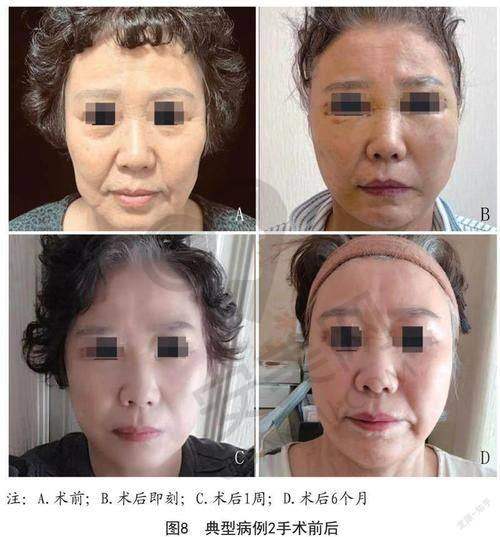术后修复情况如何？