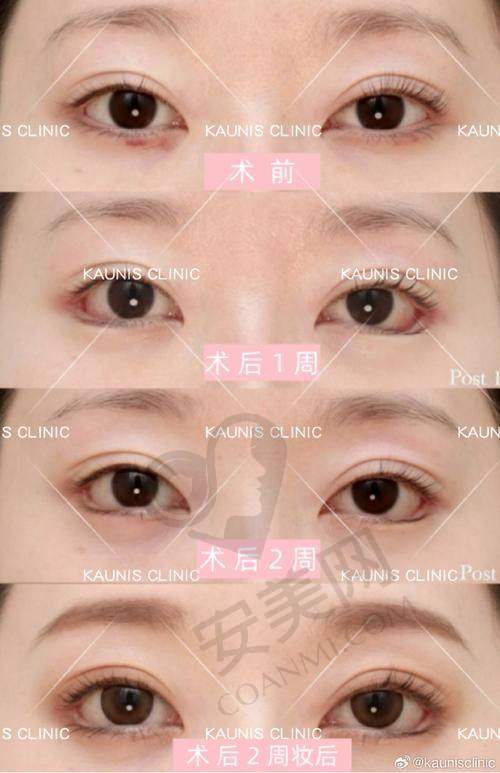 杨亚益医生——个性化眼部定制的能手