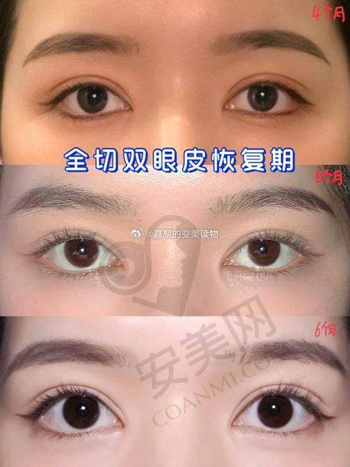 术后修复需要注意什么？