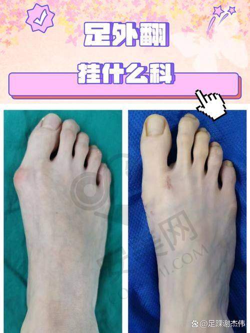 大脚骨问题对生活有哪些影响？