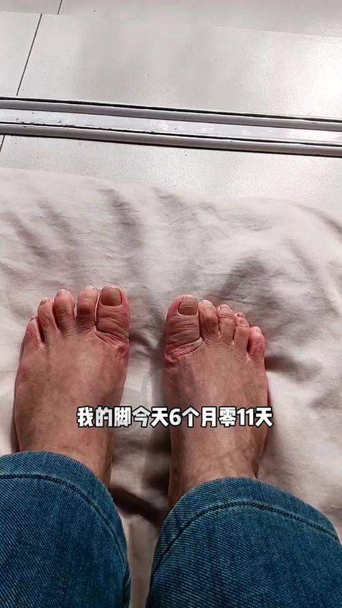 北京苏敬达拇外翻手术的术后修复注意事项有哪些？