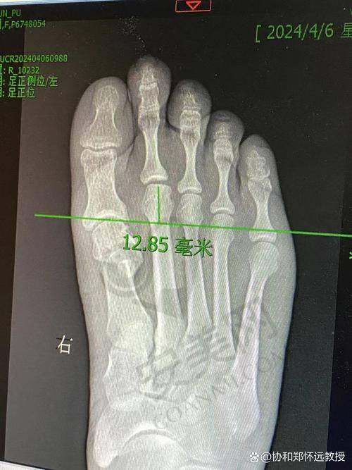 苏敬达大脚骨手术后如何护理？