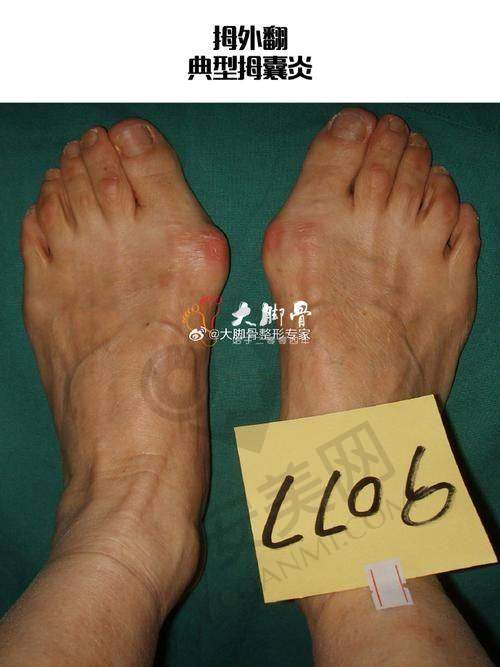 患者选择北京苏敬达拇外翻手术的真实反馈如何？