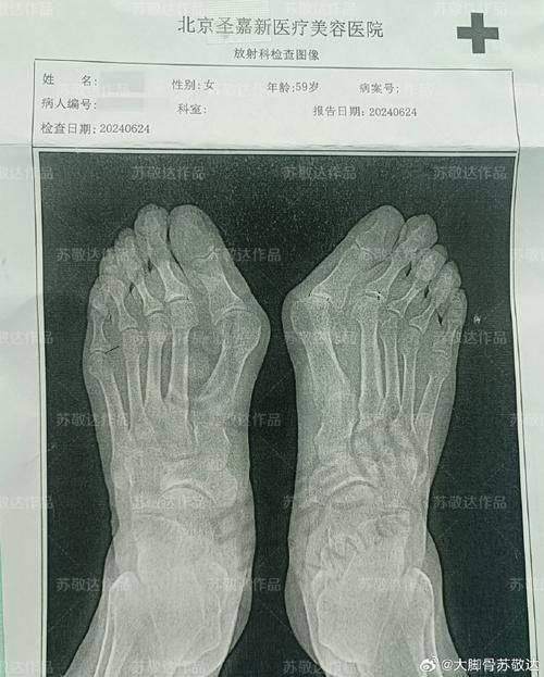 北京苏敬达医生治疗大脚骨有哪些优势？