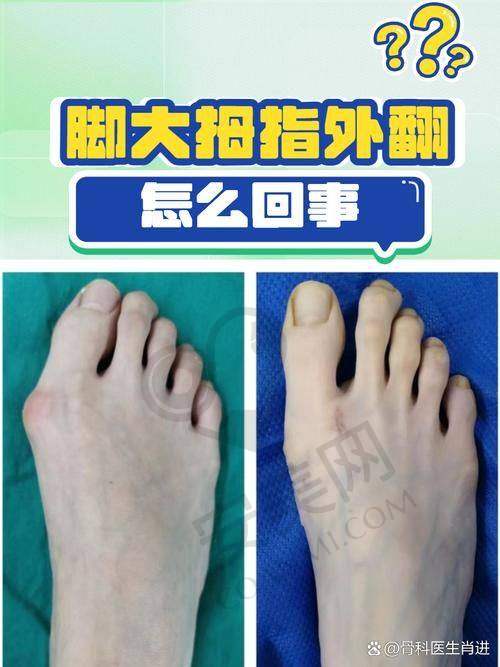 北京苏敬达医生大脚骨项目的成功实例有哪些？