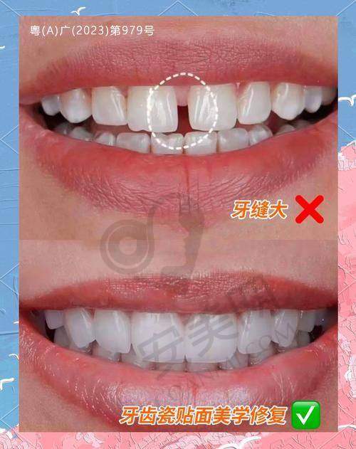 石家庄中诺口腔的爱尔创全瓷牙冠值得选择吗？