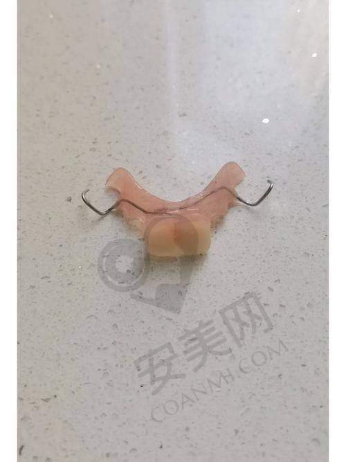 活动义齿佩戴后需要注意什么？