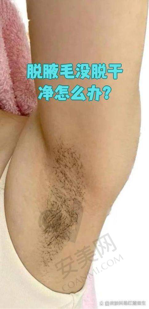 激光脱毛后成效如何？