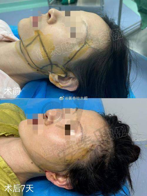 北京加减美穆宝安医生的面部提升项目怎么样?