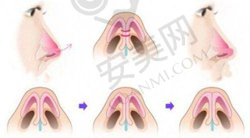 半岛超声炮治疗过程体验如何？