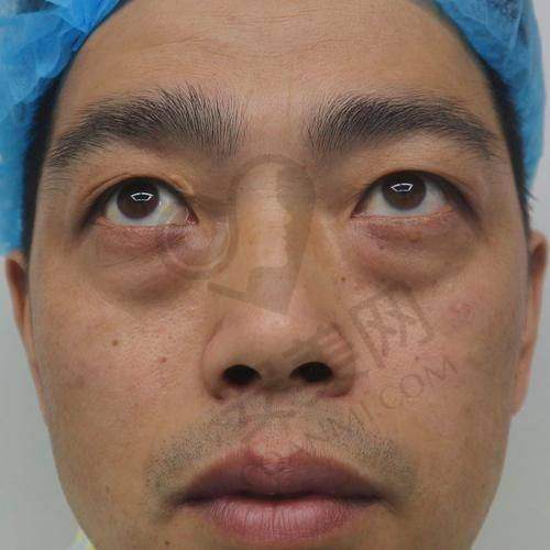 祛眼袋术后护理指南，助你修复更快