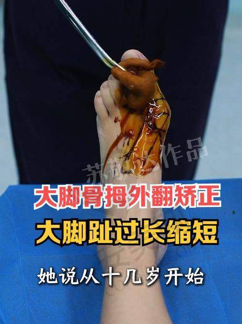术后真相：真的能当天逛街吗？